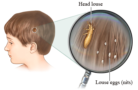 Wallace H Braden Middle School Lice 101
